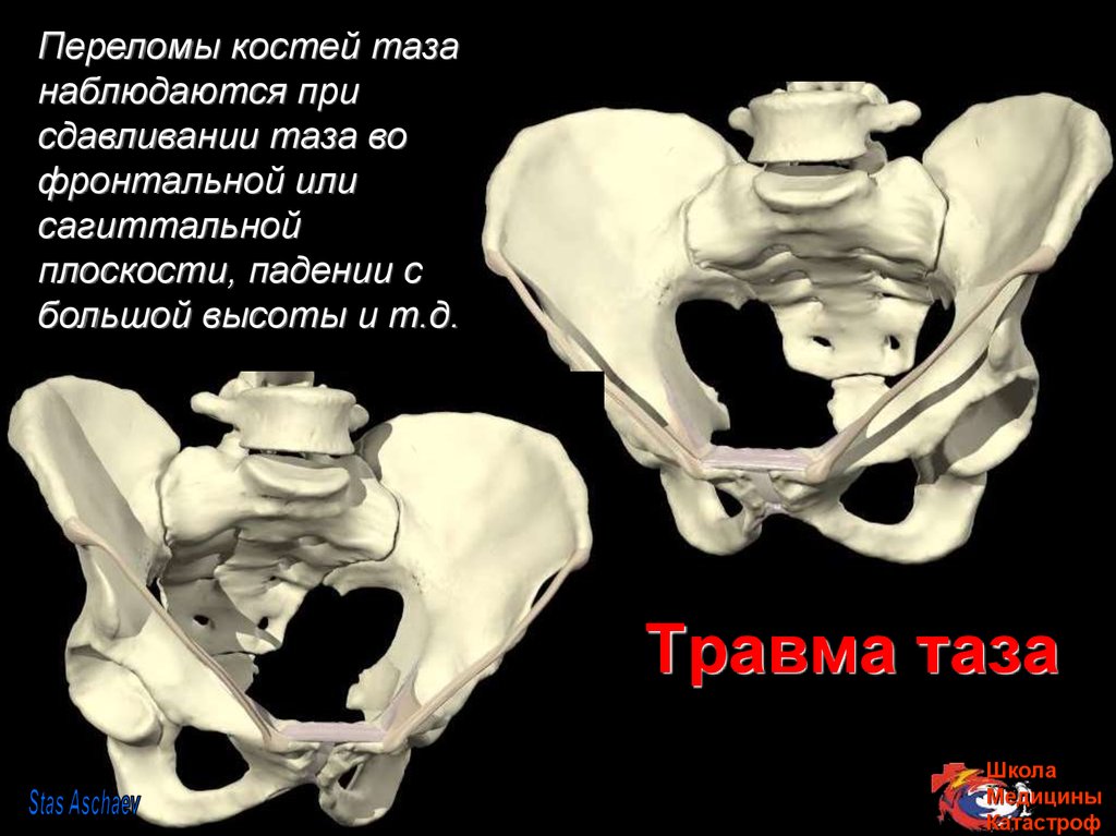 Травма таза картинки