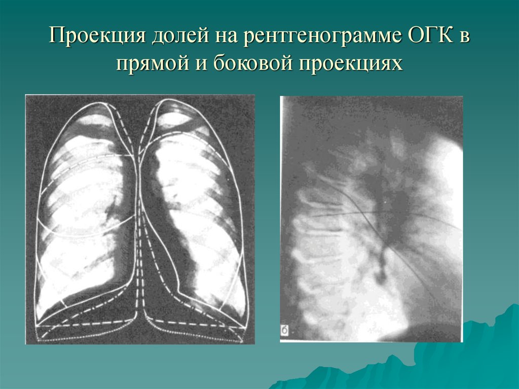 Проекция долей на рентгенограмме ОГК в прямой и боковой проекциях