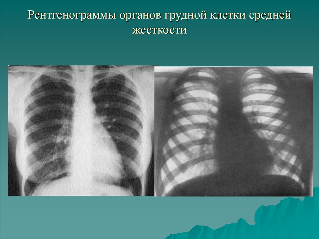 Рентгенограммы органов грудной клетки средней жесткости