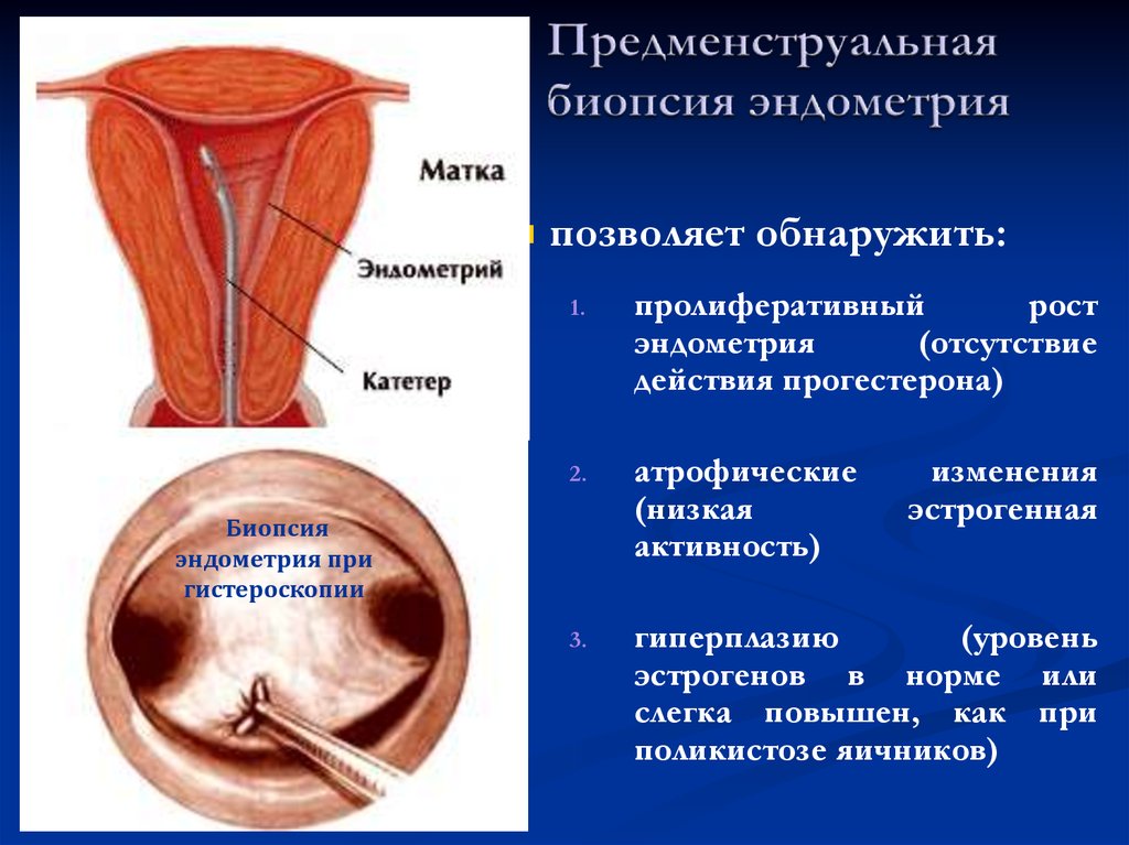 Эндометрия стенок матки