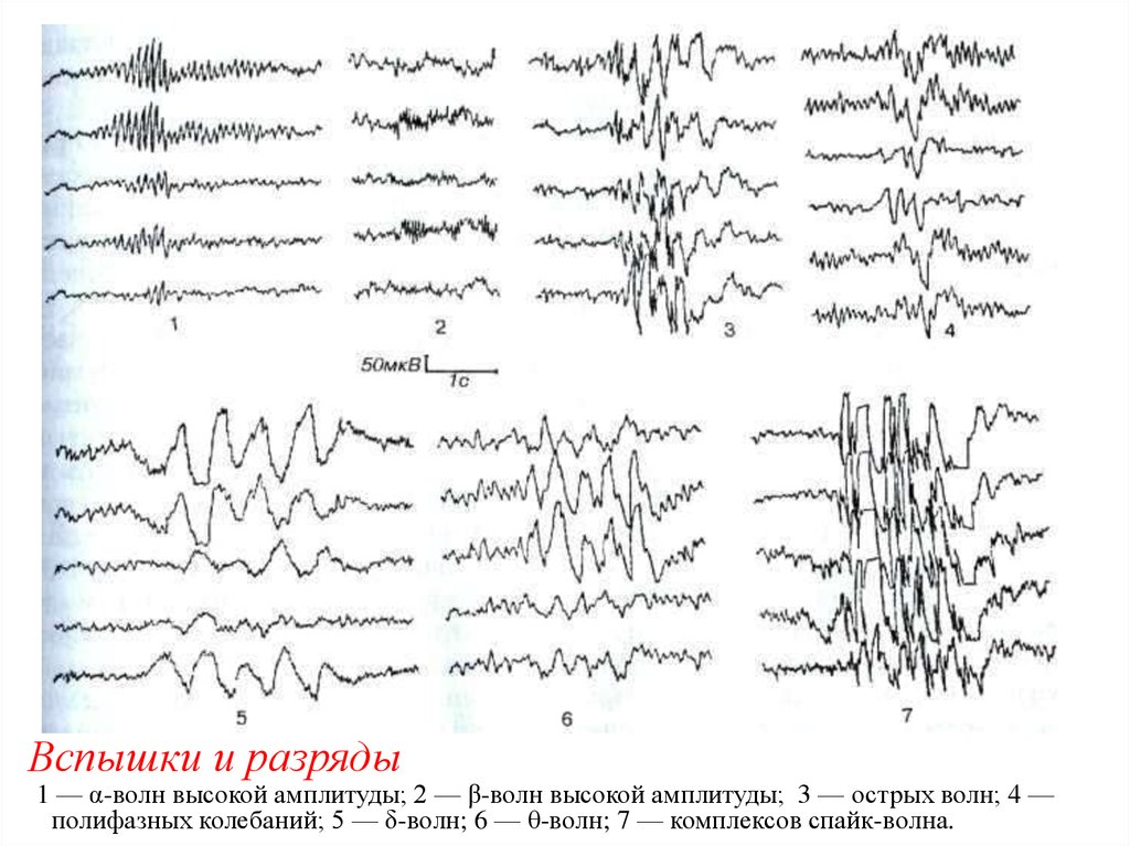 Амплитуда пароксизмальной активности. Полифазные волны на ЭЭГ. Генерализованные комплексы пик волна на ЭЭГ. Разряды пик волновой активности на ЭЭГ. Вспышки бета волн на ЭЭГ.