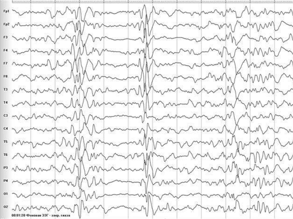 Что значит эпилептиформная активность. Эпилептиформные паттерны на ЭЭГ. Генерализованная эпилептиформная активность на ЭЭГ. Эпилептиформные феномены на ЭЭГ что это. ЭЭГ эпилепсия пик-волна.