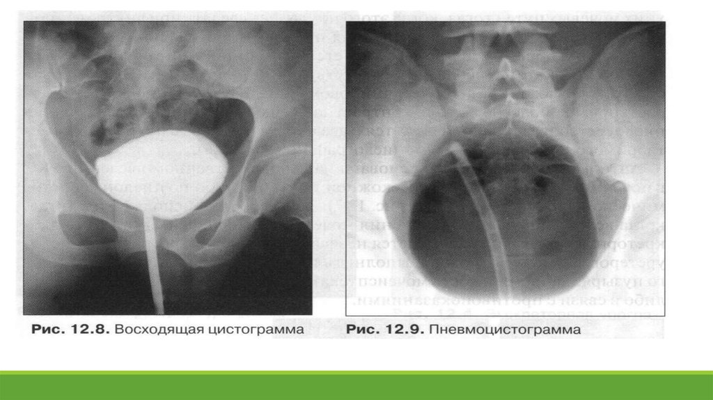 Рентгенанатомия мужского мочеиспускательного канала. Восходящая цистограмма.