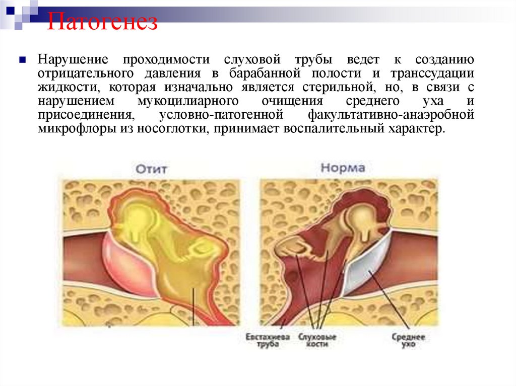 Отит слуховых труб