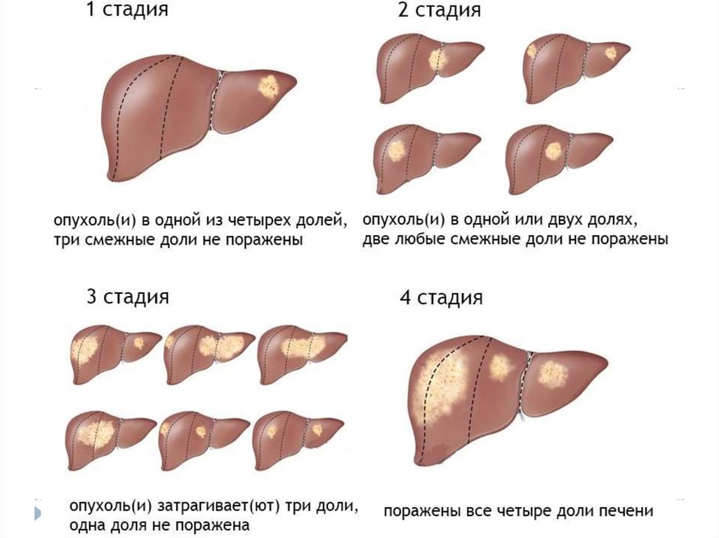 Возраст печень. Цирроз печени стадии развития. Стадии формирования цирроза печени. Стадии развития болезни печени. Цирроза печень опухоли печени.