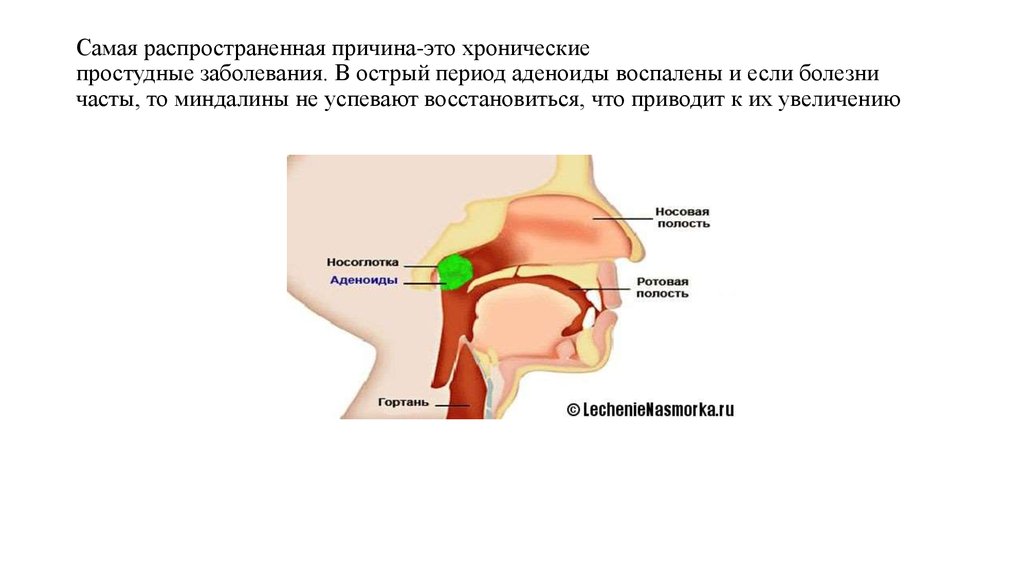 Аденоиды у детей лечен