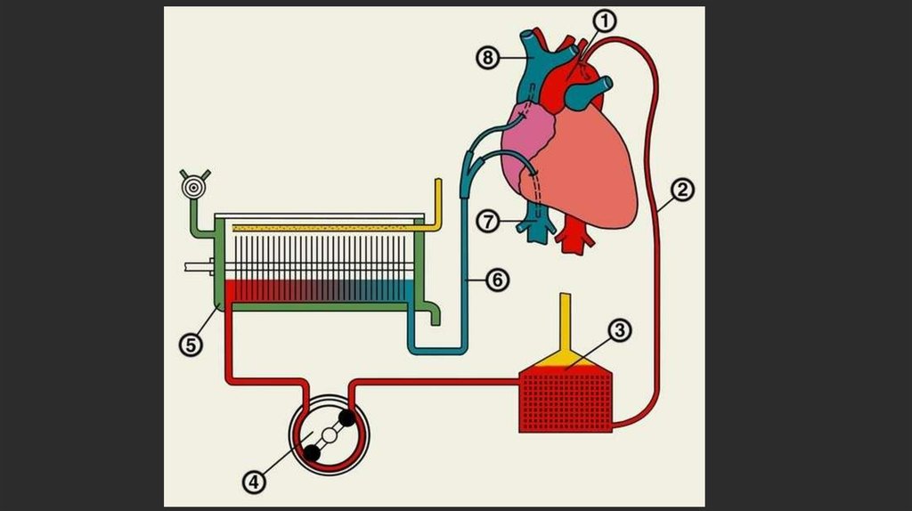 Искусственное кровообращение. АИК аппарат искусственного кровообращения. Схема подключения аппарата искусственного кровообращения. Аппарат искусственного кровообращения схема. Аппарат искусственного кровообращения принцип работы схема.