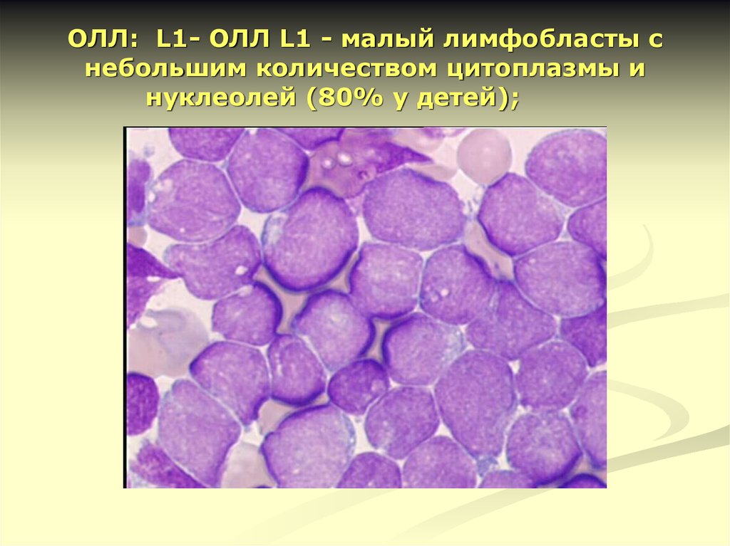 Лимфобластный лейкоз. Острый лимфобластный лейкоз л1. Лимфобластный лейкоз миелограмма. Острый лимфобластный лейкоз пролимфоциты. Олл лейкоз острый лимфобластный.