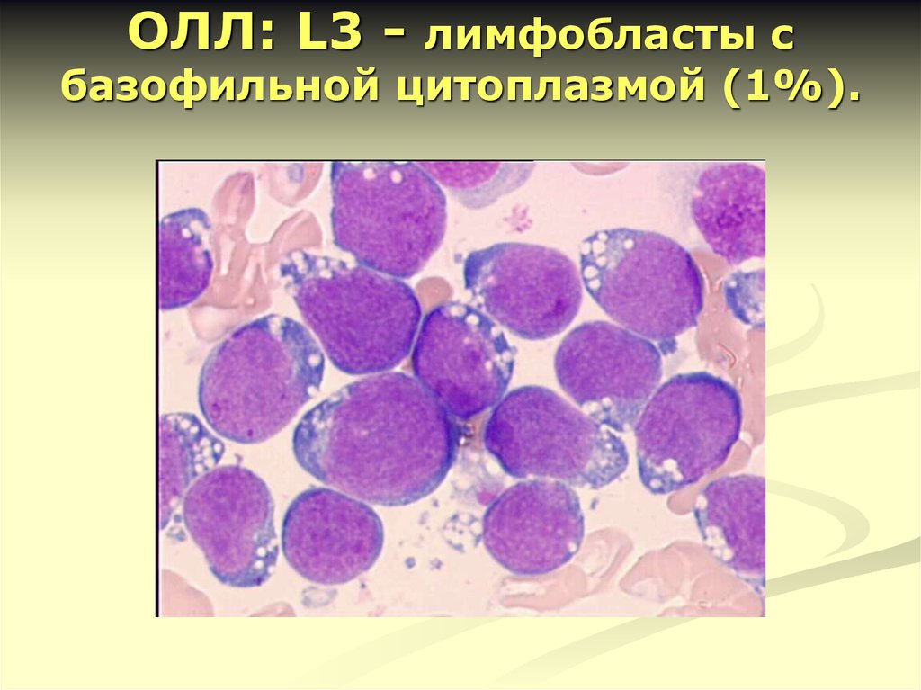 Клетка с базофильной цитоплазмой. Острый лимфобластный лейкоз пролимфоциты. Лимфоциты и лимфобласты. Острый лимфобластный лейкоз l3. Лимфобласт пролимфоцит лимфоцит.