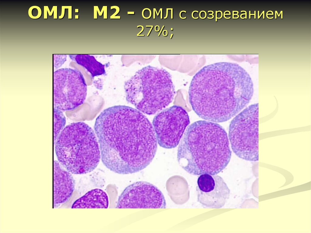 Острый миелоидный лейкоз прогноз. Острый миелобластный лейкоз (ОМЛ). Острый миелоидный лейкоз м2. Острый миелобластный лейкоз (м1-м2). Острый миелобластный лейкоз с созреванием.