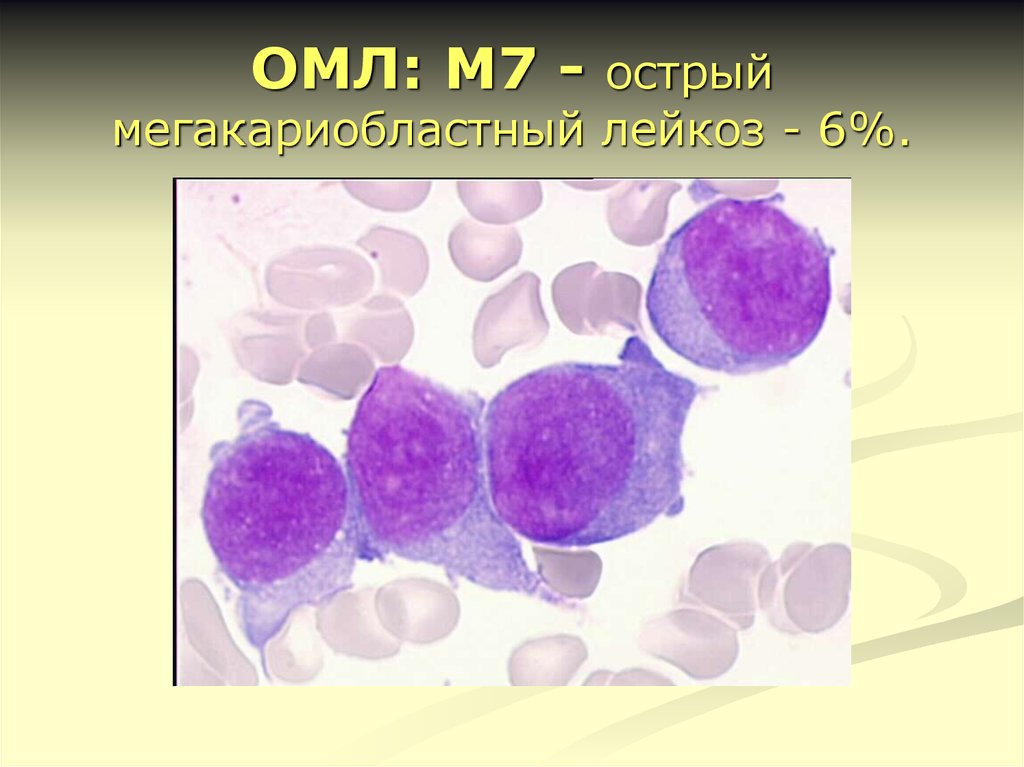 Картина лейкоза. Острый мегакариобластный лейкоз картина крови-. Острый миелобластный лейкоз м5а. Мегакариобластный лейкоз миелограмма. Острый миелобластный лейкоз атлас.