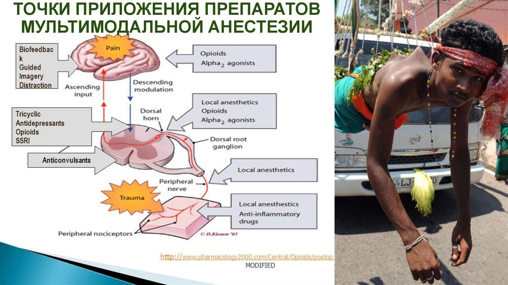 Мультимодальная анестезия презентация