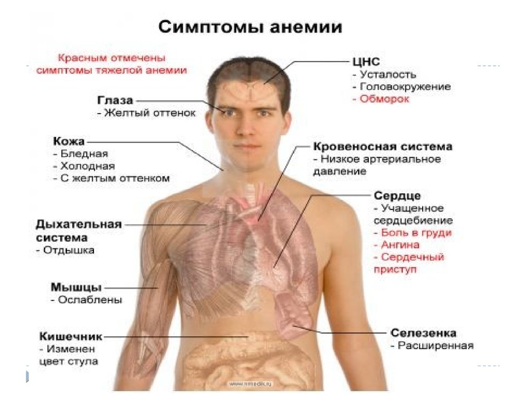 Как лечить анемию. Анемия симптомы у подростков. Малокровие симптомы у подростка. Тяжелая анемия симптомы. Приступ анемии симптомы.