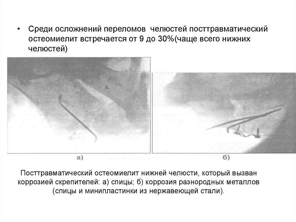 Секвестрэктомия при остеомиелите