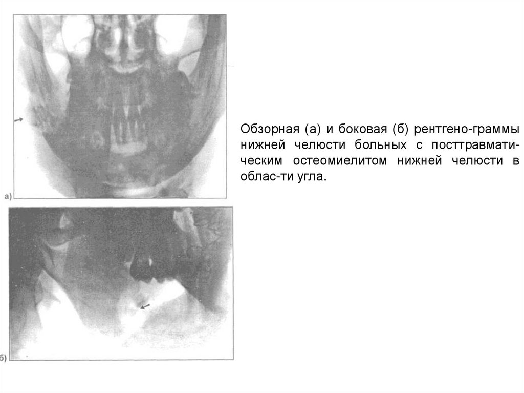 Флегмона нижней челюсти фото