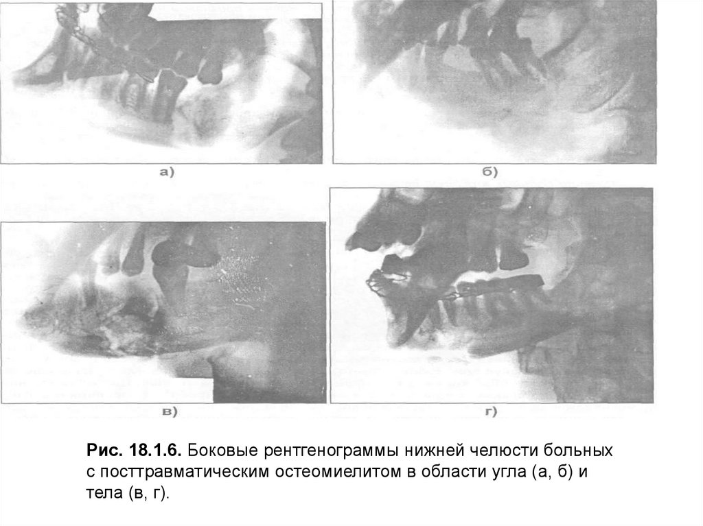 Огнестрельный остеомиелит