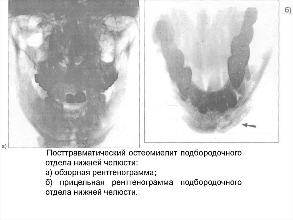 Остеомиелит нижней челюсти фото