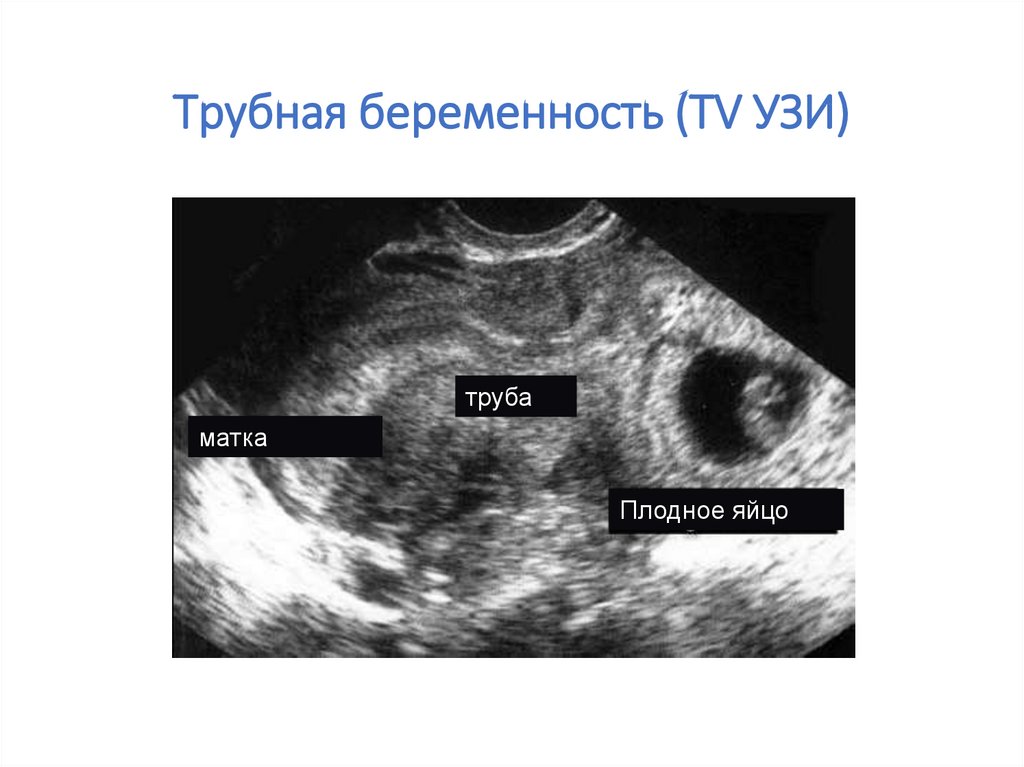 На узи видно внематочную. Внематочная Трубная беременность УЗИ. УЗИ беременности внематочная внематочная беременность. Трубная беременность УЗИ. Внематочная беременность снимки УЗИ.