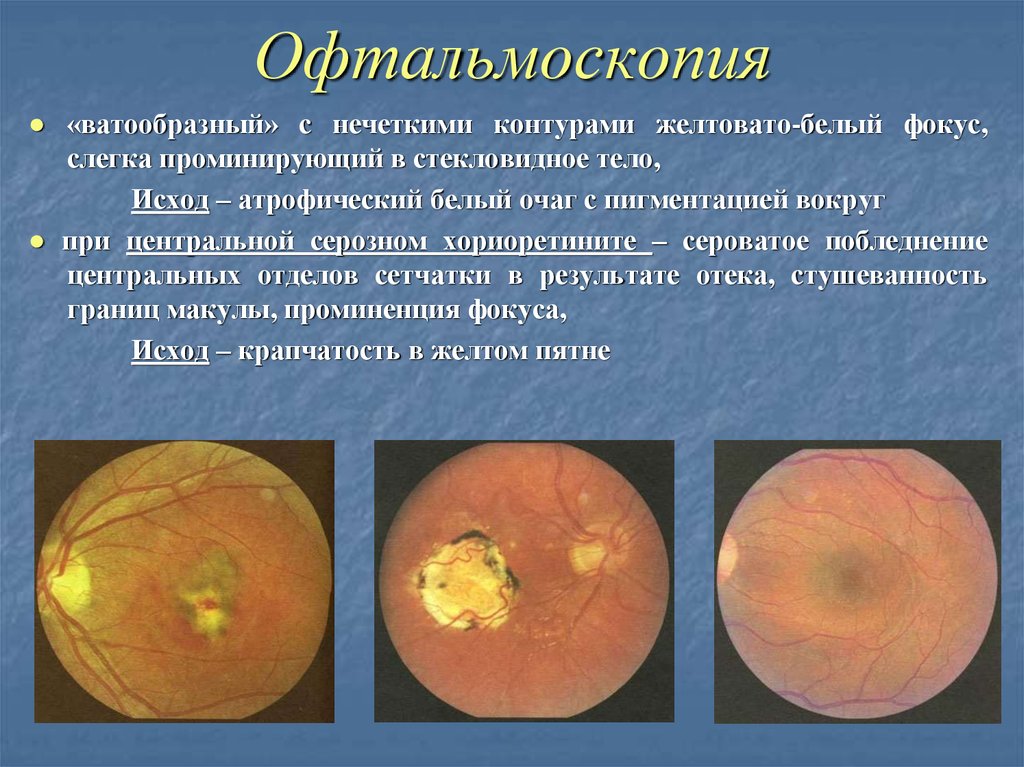 Что значит атрофические изменения. Офтальмоскопия. Офтальмоскопия глазного дна. Прямая офтальмоскопия глазного дна.