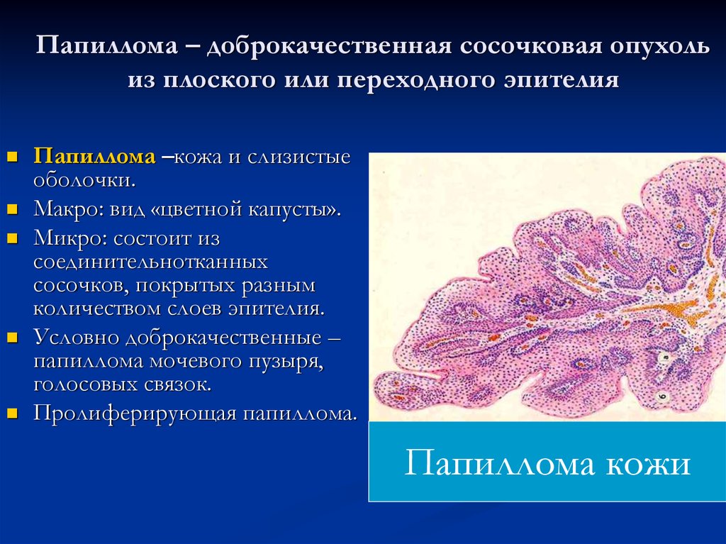 Злокачественные новообразования лимфоидной кроветворной ткани. Папиллома патанатомия микропрепарат. Эпителиальные опухоли патоморфология. Доброкачественные эпителиальные опухоли патанатомия. Плоскоклеточная папиллома гистология.