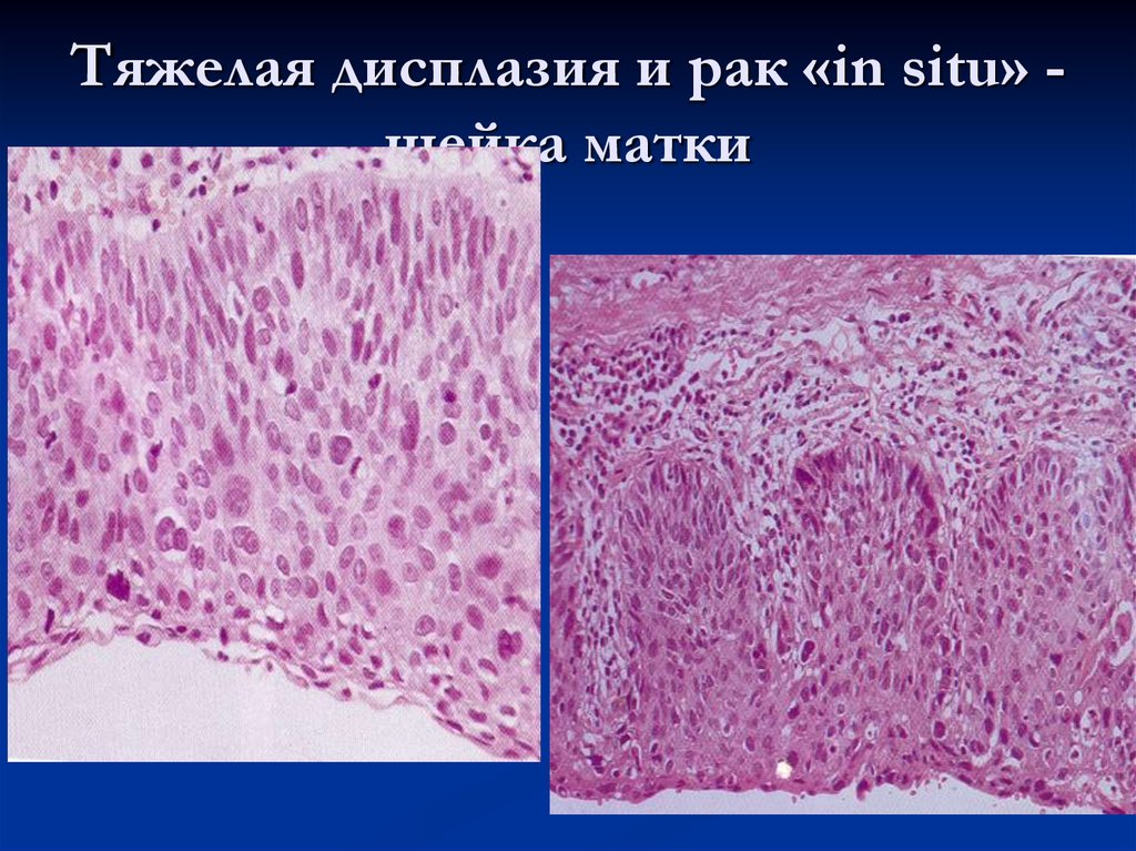 Злокачественные новообразования лимфоидной кроветворной ткани. Плоскоклеточная карцинома in situ. Плоскоклеточный эпителий. Карцинома in situ шейки матки. Опухоли кроветворной и лимфоидной ткани патанатомия.