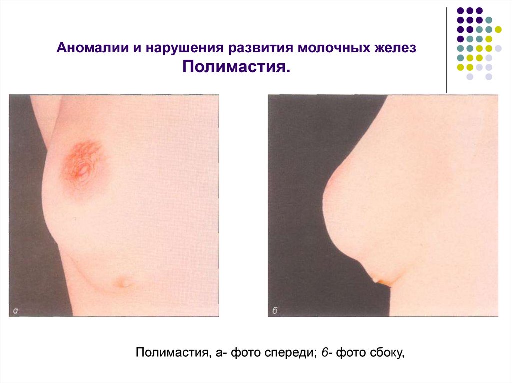 Аномалии и нарушения развития молочных желез Полимастия.