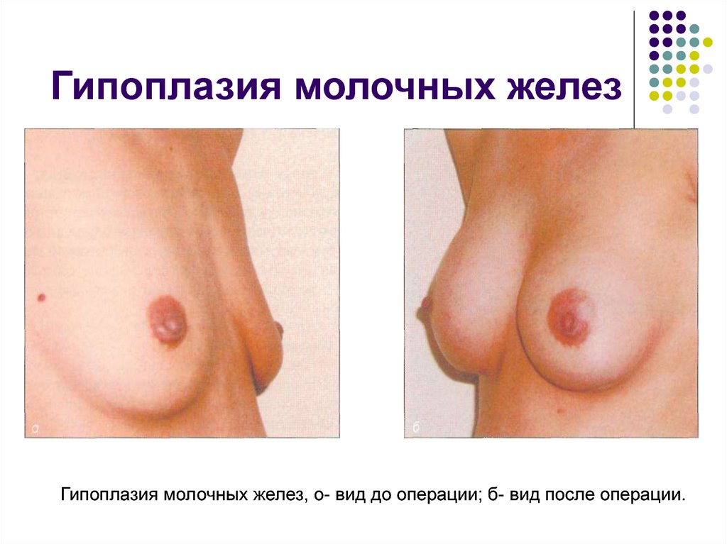Гипоплазия молочных желез