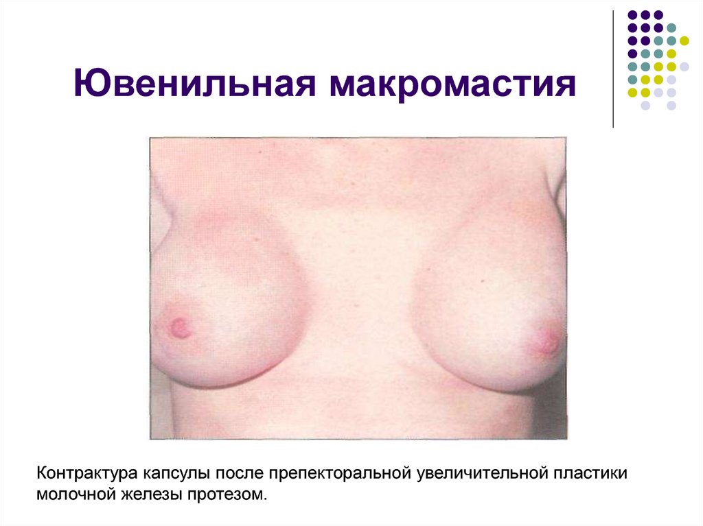 Ювенильная макромастия