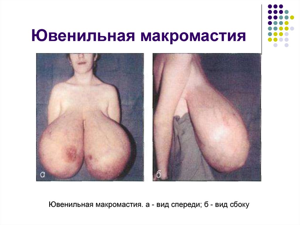 Ювенильная макромастия