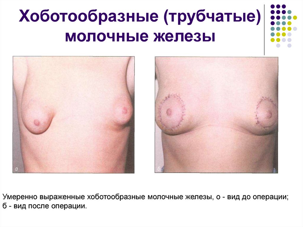 Хоботообразные (трубчатые) молочные железы