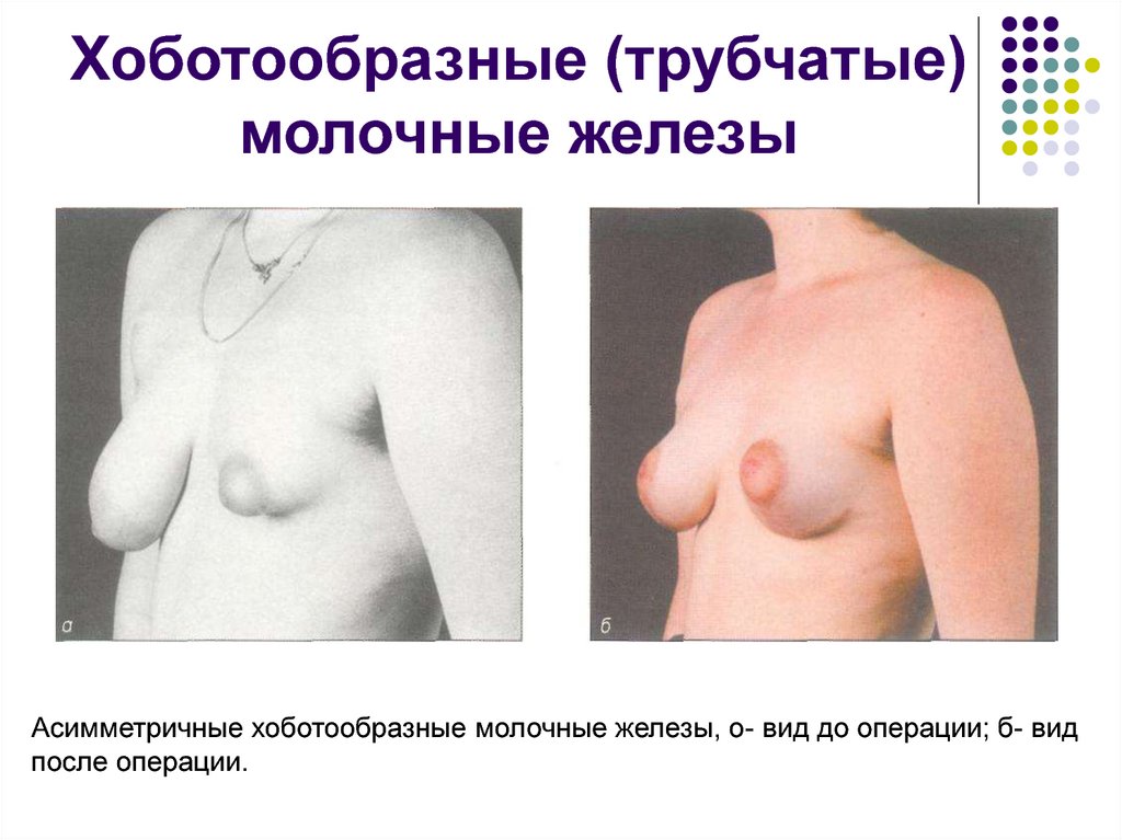 Хоботообразные (трубчатые) молочные железы