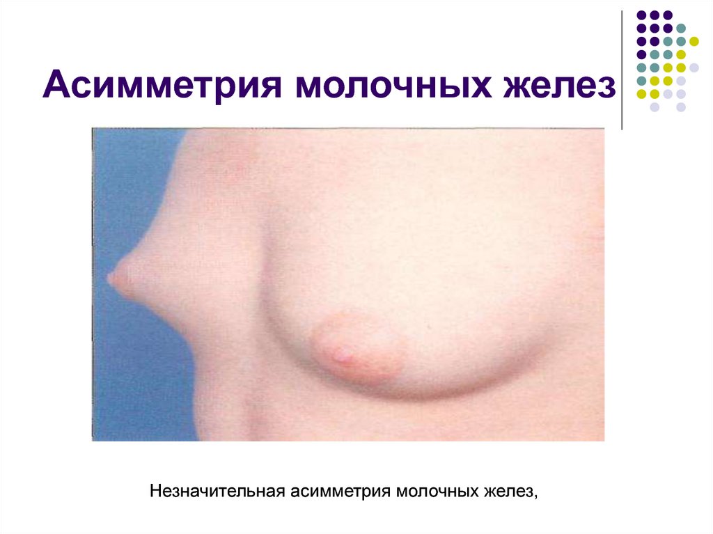 Асимметрия молочных желез