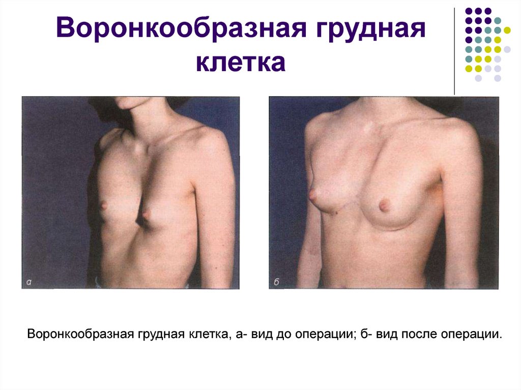 Воронкообразная грудная клетка