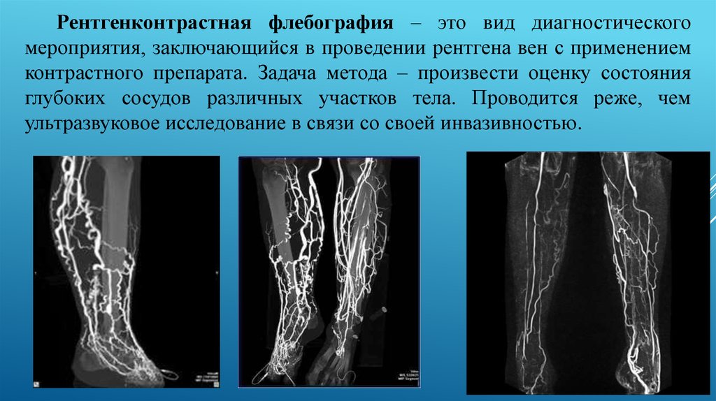 Мкб тромбофлебит нижних. Рентгеноконтрастная флебография вен нижних конечностей. Тромбоз глубоких вен флебография. Тромбоз глубоких вен презентация.