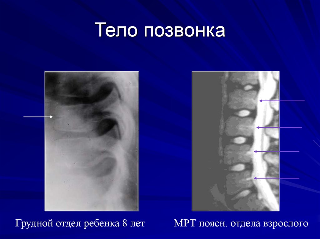 Деформация позвонков. Тело позвонка. Двояковогнутая форма позвонков. Двояковогнутая деформация позвонков. Двояковогнутая клиновидная деформация тела позвонка.