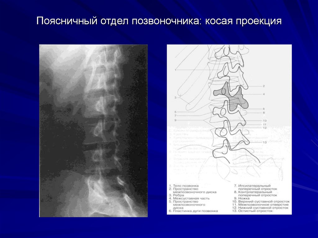 Поясница 6. Косая проекция шейного отдела позвоночника. 6 Поясничный позвонок. Косая проекция поясничного отдела. Проекция позвоночника в поясничном отделе.