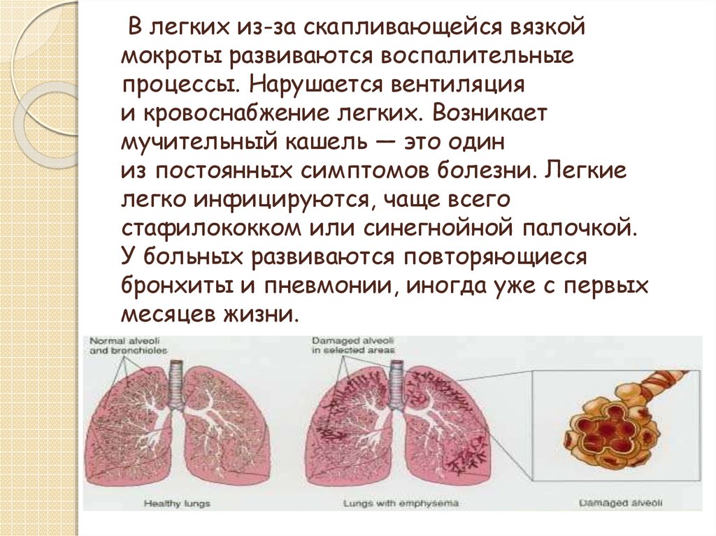 Кистозный фиброз презентация