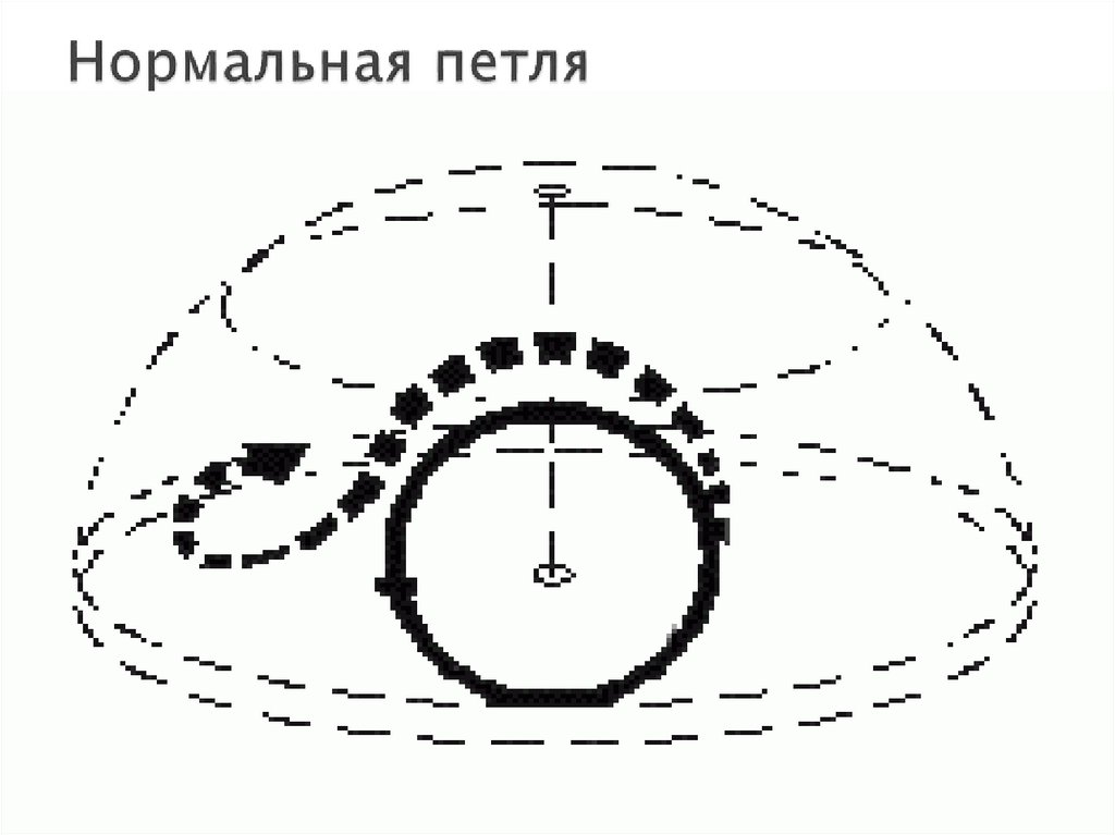 Нормальная петля