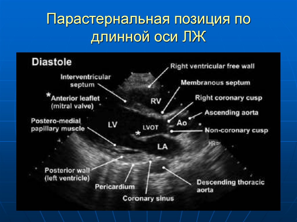 Эхо левого желудочка. Парастернальная позиция по длинной оси лж. Створки аортального клапана на ЭХОКГ по длинной оси. Парастернальная позиция длинная ось левого желудочка. Оси сердца Эхо кг.