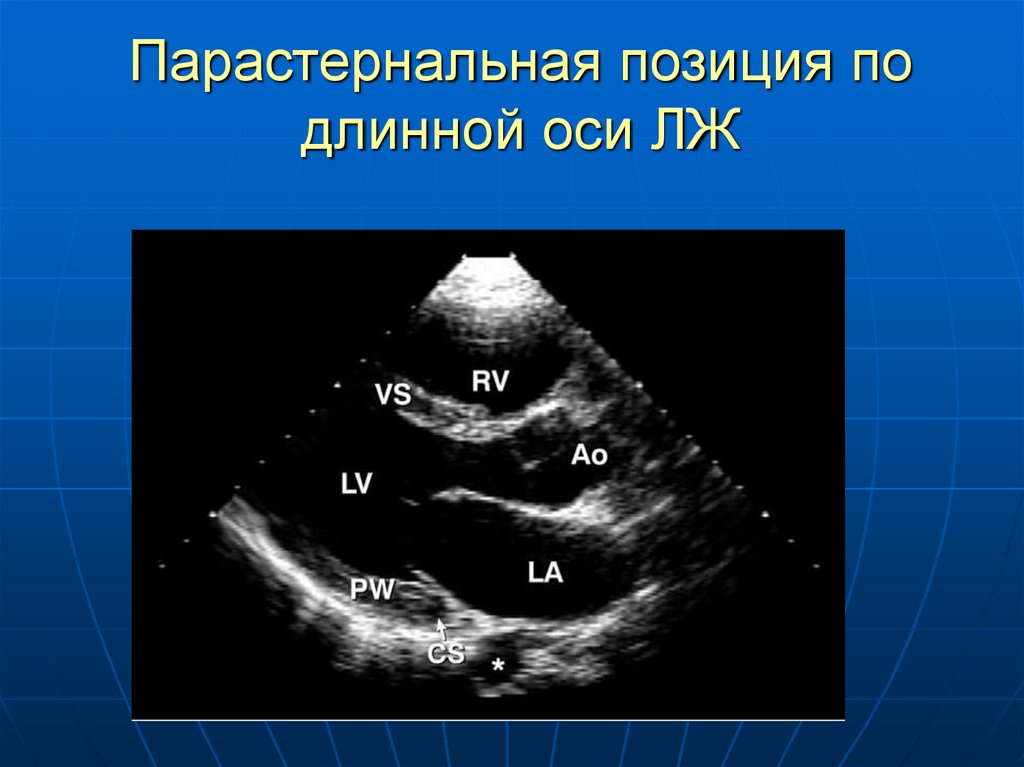 Длинная ось. Парастернальная позиция в ЭХОКГ. Парастернальная позиция длинная ось ЭХОКГ. Эхо парастернальный доступ. Парастернальная позиция по длинной оси лж.