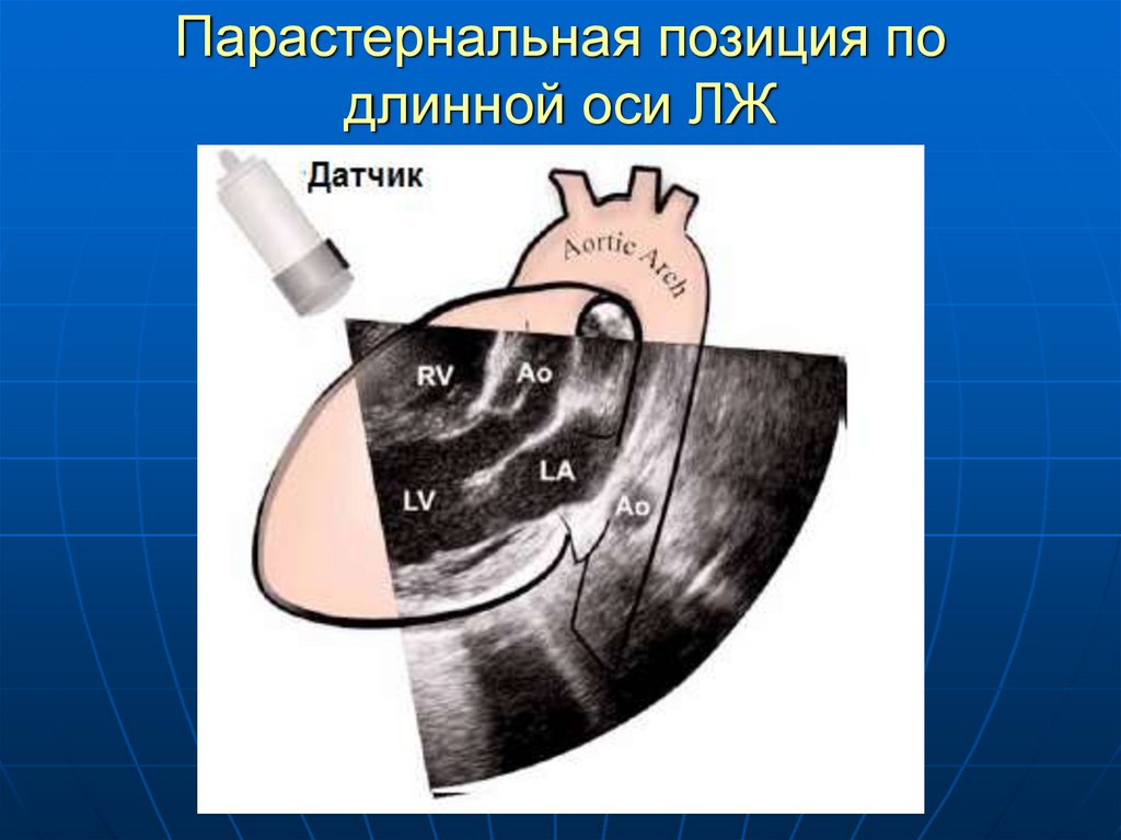 Длинная ось. Эхо кг парастернальная позиция длинная ось. Парастернальная позиция длинная ось левого желудочка. Эхокардиография парастернальная позиция по длинной оси. Парастернальная позиция длинная ось.