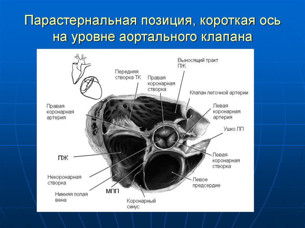 Правый желудочек размеры. Парастернальная позиция короткая ось на уровне аортального клапана. Короткая ось левого желудочка на уровне аортального клапана. Парастернальная позиция по короткой оси аортального клапана. Парастернальный доступ короткая ось на уровне аортального клапана.