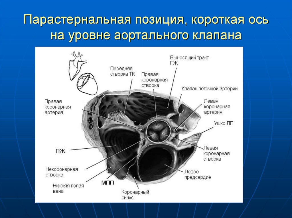 Расхождение створок аортального клапана