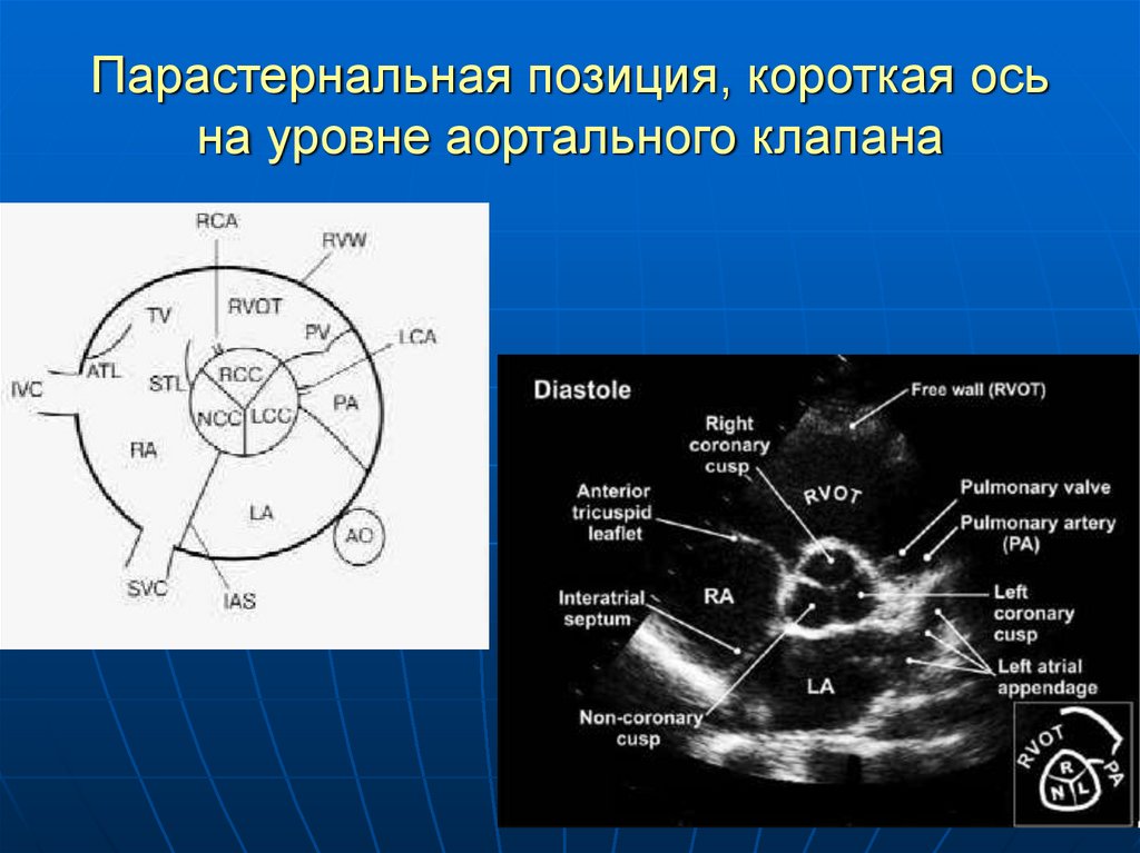 Парапротезная регургитация аортального клапана