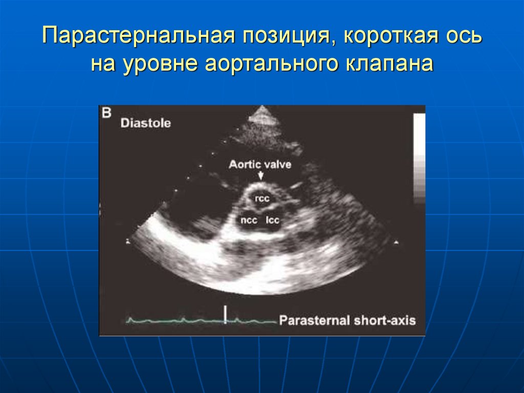 Уплотнение аорты аортального клапана