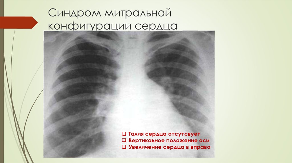 Митральное сердце. Митральная конфигурация сердца рентген. Гипертрофия левого желудочка рентген. Митральная и аортальная конфигурация сердца.