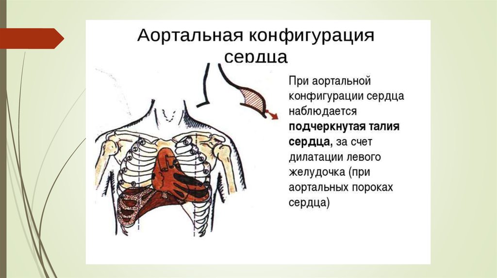 Аортальная конфигурация сердца