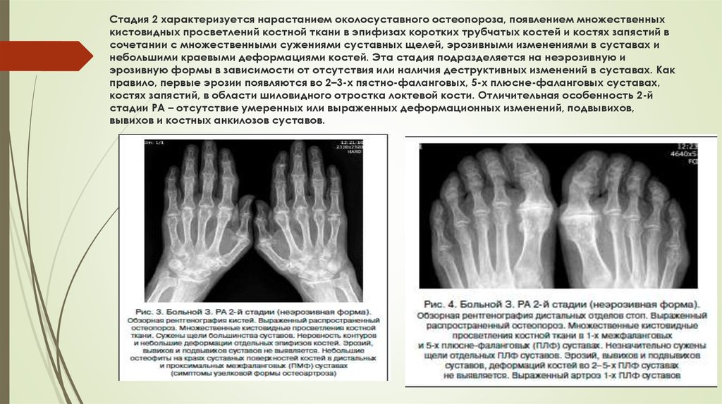 Разряжение костной ткани. Эпифизарный остеопороз ревматоидный артрит. Эпифизарный остеопороз костей кистей. Эпифизарный остеопороз, сужение суставной щели.. Околосуставной остеопороз кистей рентген.