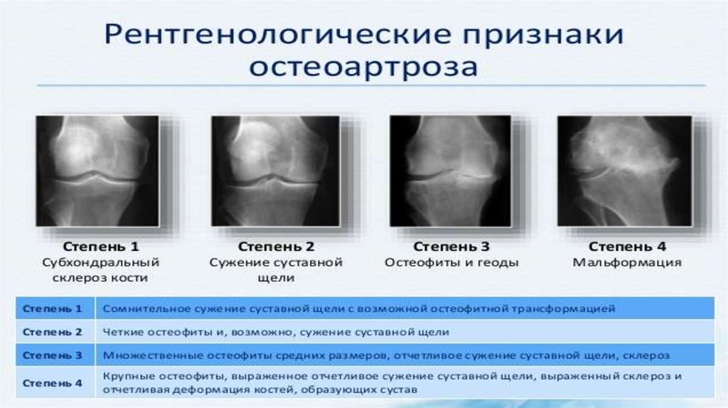 Гонартроз по утвержденным клиническим рекомендациям. Рентген стадии остеоартроза. Остеоартроз (деформирующий остеоартроз). Деформирующий остеоартроз рентгенологические стадии. Рентгенологические стадии остеоартроза коленного сустава.