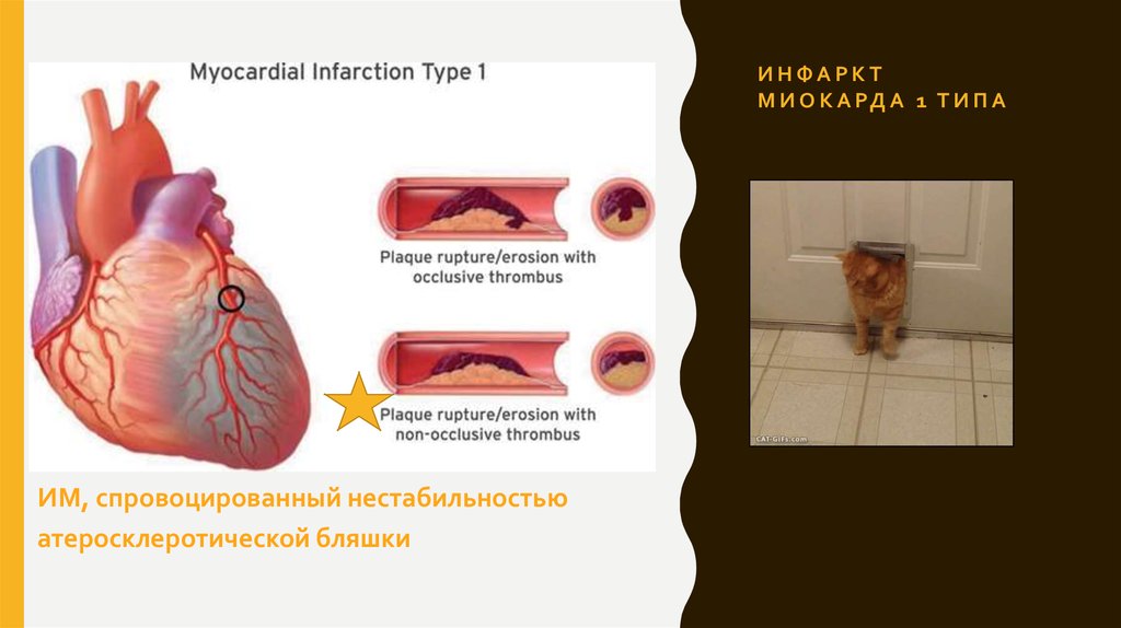 Инфаркт миокарда 1 типа